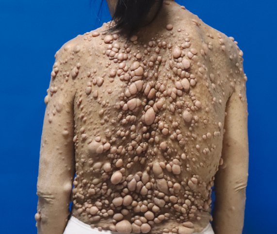 Clinical photograph showing numerous cutaneous neurofibromas across the back in neurofibromatosis type 1.